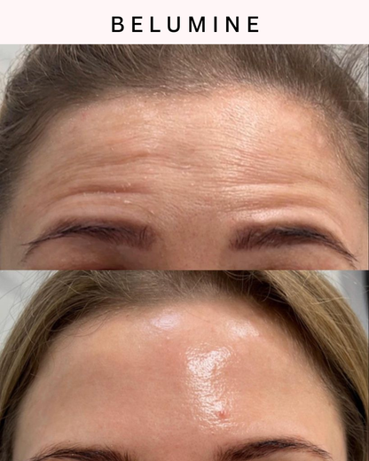 Silikónová náplasť na vrásky na čele