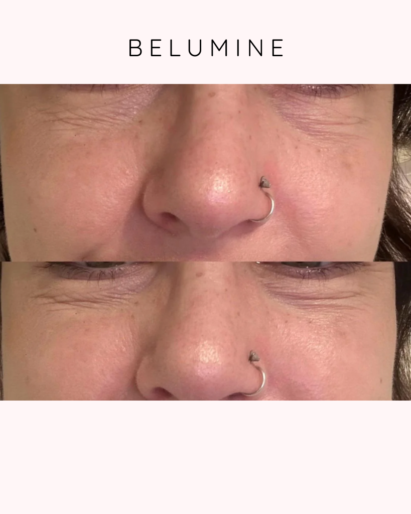 Silikónová náplasť na vrásky okolo očí