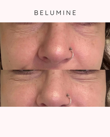 Silikónová náplasť na vrásky okolo očí