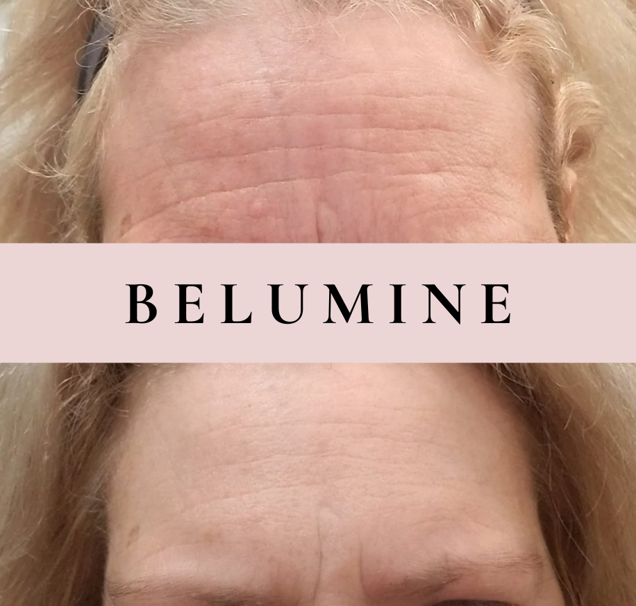 Silikónová náplasť na vrásky na čele