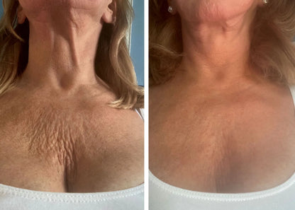 Silikónová náplasť proti vráskam na dekolte