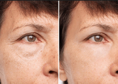 Silikónová náplasť na vrásky okolo očí